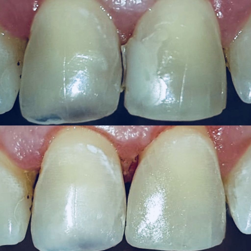 Реставрация зубов композитом