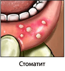 Лечение стоматита у ребенка в Москве