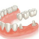 Мостовидные протезы с опорой на свои зубы