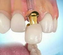 Имплантация фронтальных зубов