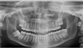 Панорамный снимок челюсти в стоматологии