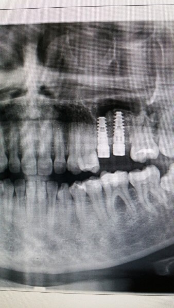 Имплантация зубов Москва