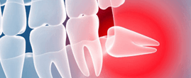 Удаление зубов 
