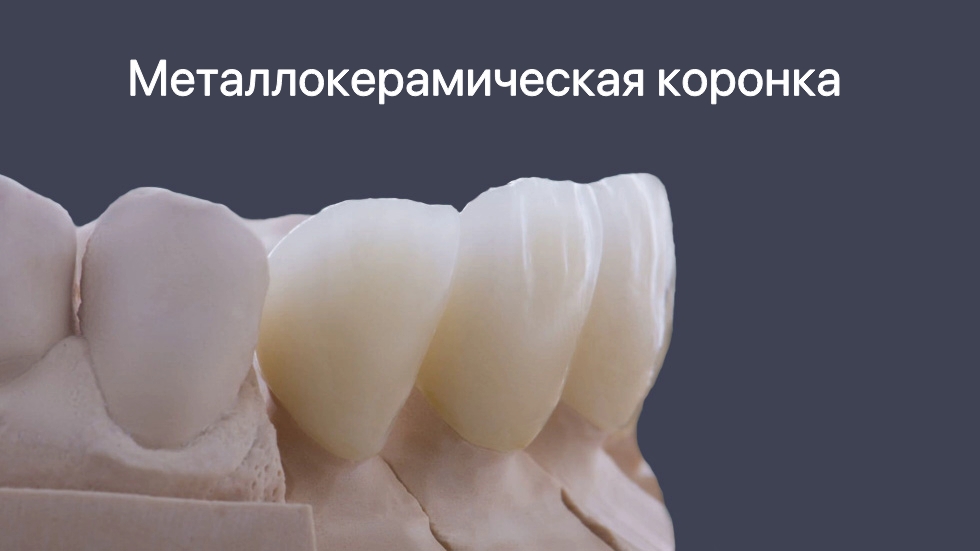Протезирование зубов 